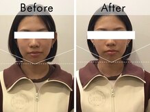 ハリラウンジ 恵比寿本店(Hari Lounge)/美容鍼専門サロン Hari Lounge