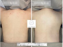 ラヴィオーラ 神戸三宮店(La Viora)/ダイヤモンドハーブピーリング