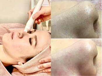 アンシャンテ(En chan te)の写真/ホームケアでは落としきれない毛穴汚れがスッキリ！ハイドロスプラッシュ+冷却美容コース★10450円⇒6800円