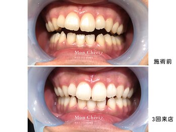 モンシェリ 広島店(Mon Cheri)/ホワイトニングBefore→After