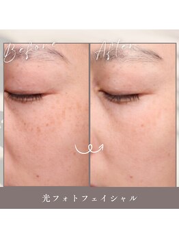 ティエルプラス(tiele+)/光フェイシャル3回