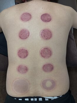 ほぐせる スター鍼灸接骨整体院 竹ノ塚 竹ノ塚東口駅前店/カッピング!