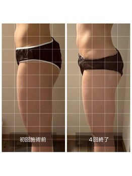 フィエルテ 甲斐敷島(FIERTE)/ハイパーナイフ beforeafter