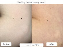 ヒーリングハーツ(Healing Hearts)/腕のシュガーリング！肌触り良き