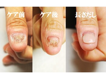 ジュジュ(Juju)/トラブル爪　長さだし　徹底ケア