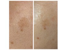 ココスタイルビューティー(COCOSTYLE beauty)の雰囲気（ララピールケア！シミ改善！毛穴レス！）