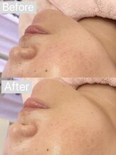 リンダ 西宮店(LINDA)/ハイドロ×プラズマ