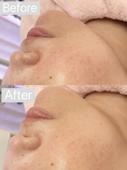 リンダ 西宮店(LINDA)/ハイドロ×プラズマ