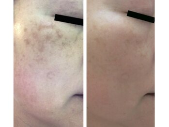 Nビューティー/セルフシミケアプログラム