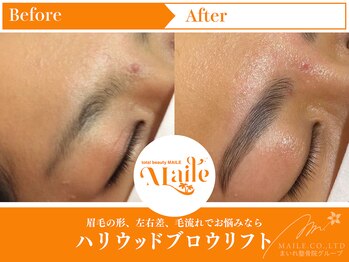 まいれ鍼灸院整骨院 整体院 草津院/ハリウッドブロウリフト/美眉