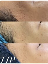 アリス(ALICE)/肌の凹凸にはハーブピーリング