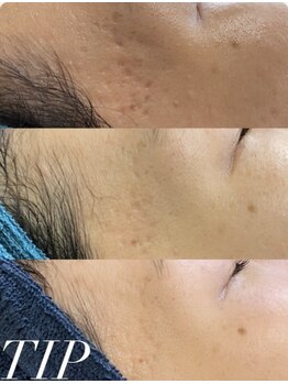 アリス(ALICE)/肌の凹凸にはハーブピーリング