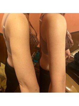 リハーツ(RE;heartz)/★－４℃脂肪冷却★大人気【脚】