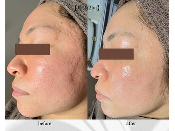 アン ビューティー(ann beauty)の写真/医師監修"乳酸ピーリング"最新韓国肌管理◎ララピールの上位版《ダクトピール》×ヒト幹エクソソーム導入