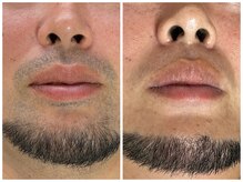 フェリス(FELIZ)/デザイン脱毛も得意