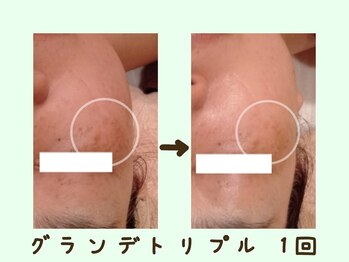 ラブニール 恵比寿店/【グランデ光エステ】