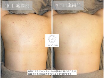 ラヴィオーラ 神戸三宮店(La Viora)/ダイヤモンドハーブピーリング