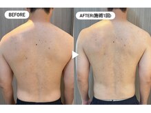 ブライダル前に肌改善と引き締めケア◎背中・二の腕・首デコルテ