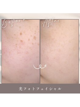 ティエルプラス(tiele+)/光フェイシャル8回