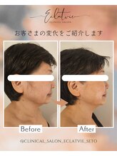 エクラヴィ(Eclatvie)/６０代★施術事例