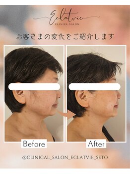 エクラヴィ(Eclatvie)/60代★施術事例
