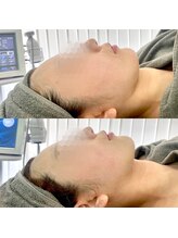 カンナムビューティー/オンダリフト/表参道/ララピール