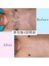 ソテ ボー(Sauter beau)/男性脱毛 胸4回施術