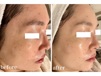 リリィブラン(Lily branc)/毛穴ニキビケア/美白ピーリング