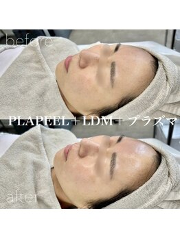 イロハ(IROHA)/プラピール+LDM+プラズマ