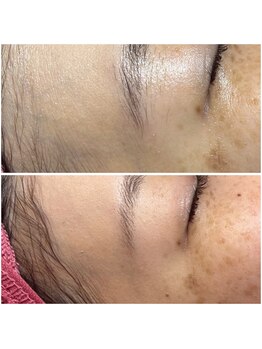 リンク(LiNK)/ハーブピーリング