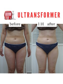 アップルミント/＜痩身＞before・after