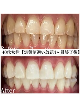 ホワイト 福岡博多店(WHITE)/ホワイトニングビフォーアフター