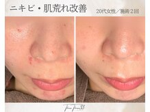 スリースリー 恵比寿(THREE THREE)/ニキビ・肌荒れケア