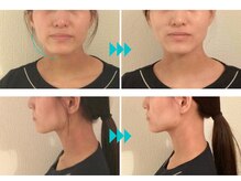 マキシフォート 名駅店(Maxifort)/エラ張り解消得意です☆