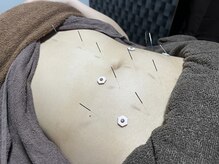 オレンジフラワープラス(orangeflower+)/強いストレスにはお腹の鍼灸施術