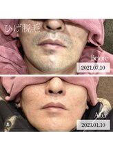 ワックスサロン ジー(waxsalon Gee!)/【ヒゲ×脱毛】