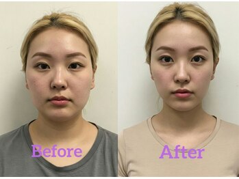 なごやの森/小顔・輪郭矯正ビフォーアフター