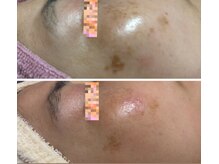 トータルビューティー ココ(Total Beauty CoCo)/40代・シミケア肌質改善