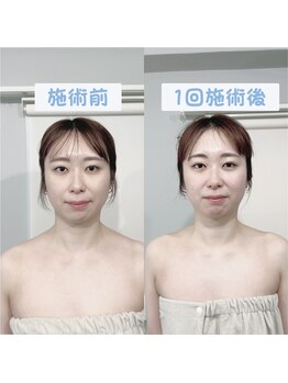 ビーキュート 渋谷北参道店(BE-CUTE)/Before・After 1回施術