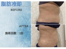 ユアーズビューティー(YOURS beauty)/脂肪冷却