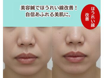 ピュアハリ/沖縄美容鍼 効果