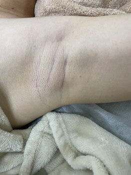 ナノハナ/鹿沼市の全身脱毛美容室ナノハナ