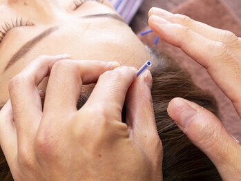 クシロ鍼灸整骨院/【美容鍼】やさしい美容鍼