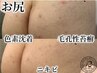 剥離あり【リベル】ハーブピーリング《お尻》2千円商品券付!黒ずみ等￥22000