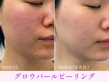 オーシャンブルー 大分店(OCEAN BLUE)/グロウパールピーリング