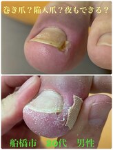 巻き爪じゅん 千葉駅前店/巻き爪？陥入爪？夜も出来る？