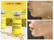 カピリナスパ(Ka.Pilina Spa)/LemonBottle症例