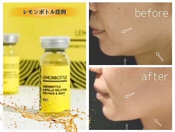 カピリナスパ(Ka.Pilina Spa)/LemonBottle症例