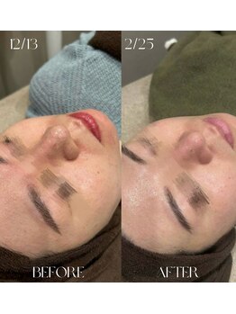 #美容革命ラボ 福岡春吉店/ハイドラ【天神春吉】