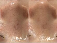 マシェ バイ マユ(Mache by Mayu)/黒ずみすっきり！